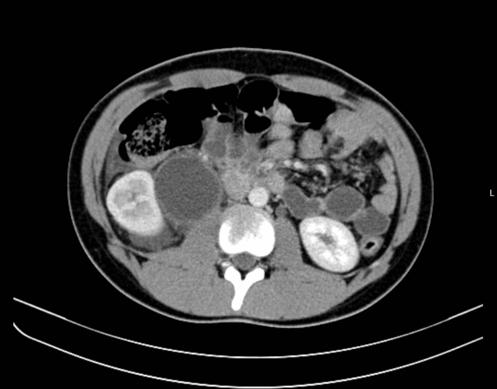 Enhanced Abdominal CT showing right hydronephrosis with dilatation of the renal pelvis and densification of the perirenal fat